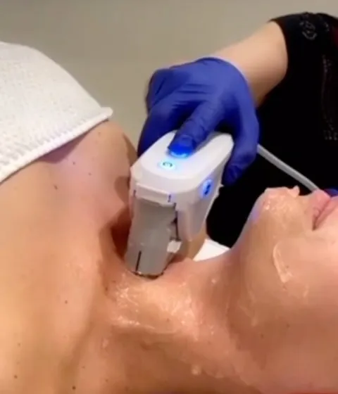 Endolift